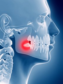 3d rendered illustration of an impacted wisdom tooth