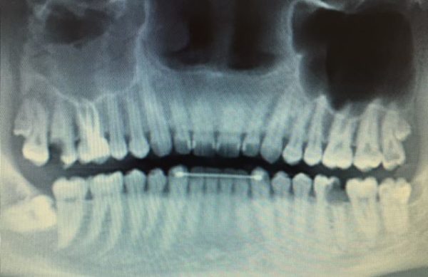 Röntgenbild von Gebiss - Oralchirurgie.